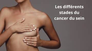 Les différents stades du cancer du sein