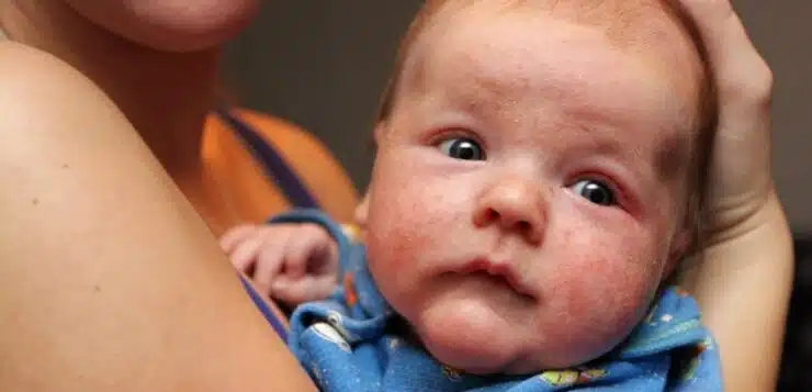 Les signes d'intolérance au lait bébé chez les nourrissons